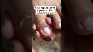 101% Satisfying 😱 INGROWN TOENAIL REMOVAL 💅😍 || Compilation Part 2