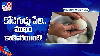 Eggs explosion :  కోడిగుడ్డు పేలి.. ముఖం కాలిపోయింది! - TV9