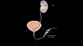 RIRS - Retrograde Intra Renal Surgery