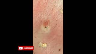 Huge pimple popping satisfying video   Blackhead Extraction Asmr