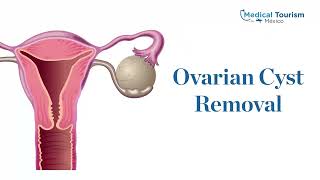 Getting ovarian cyst removal with Nogales´s top gynecologist - Medical Tourism