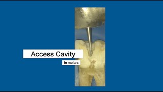 Access Cavity Preparation for molars