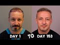 HAIR TRANSPLANT TIMELAPSE | DAY 1 TO DAY 153 | GROWTH IN 5 MONTHS |  BEFORE & AFTER