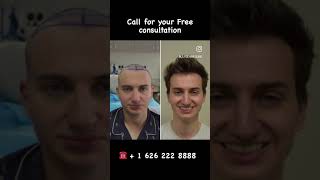 Before and After FUE Hair Transplant #fue #hairtransplant #fuehairrestoration #fuehairtransplant