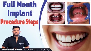 డెంటల్ ఇంప్లాంట్స్ || Full Mouth Dental Implants Procedure In Telugu || Eledent Dental Hospitals