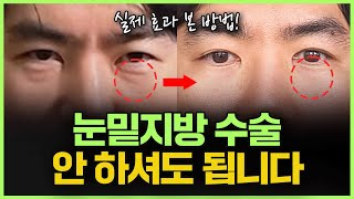 수술 없이 ‘눈밑 지방’ 없애는 법 | 