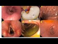 some normal endoscopic features of the gut