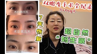 拯救被双眼皮贴“搞垮”的眼睛！术后的”妈生眼“真的太好看了！双眼皮修复手术vlog