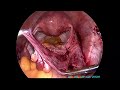 laparoscopic removal of para ovarian cyst i dr. rajeev agarwal