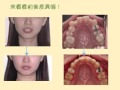 貝爾牙齒矯正日記 搶救牙亂大作戰