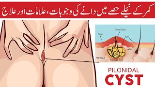 What is Pilonidal Sinus in Urdu | Pilonidal Infection Symptoms, Diagnosis & Treatment - Excision