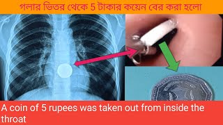 গলার ভিতর থেকে 5 টাকার কয়েন বের করা হলো  A coin of 5 rupees was taken out from inside the throat