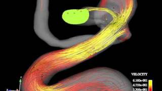 脳動脈瘤の血流シミュレーションの可視化