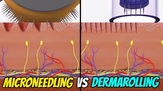 DERMAROLLER vs DERMAPEN what's the difference ?