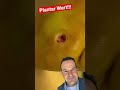 AMAZING PLANTAR WART REMOVAL! 😱#shorts