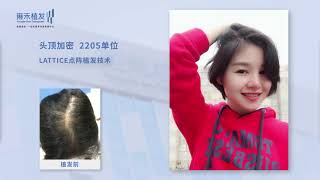 珠海女性植髮頭頂加密種植技術2205單位！效果曝光Yonghe hair transplant