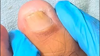 Ep_7353 Foot nails skin removal 👣 ชิ้นนี้..แค่น้ำจิ้ม 😄 (clip from Thailand)