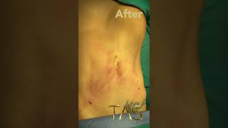 laser skin tightening and Laser liposuction without any scars! by Dr. TAS