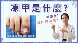 【群英皮膚科】凍未條！凍甲痛痛痛😖一直復發怎麼辦？ | 劉奎蘭醫師