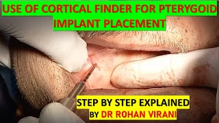 USE OF CORTICAL FINDER FOR PTERYGOID IMPLANT PLACEMENT -STEP BY STEP EXPLAINED BY DR ROHAN VIRANI