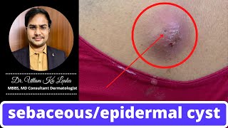 Treatment of Sebaceous/epidermal cyst/Skin me hone wala ganth ka karan aur ilaz/Dr Uttam kumar Lenka