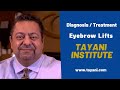 Eyebrow Lifts | Tayani Institute