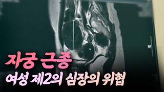 가장 흔한 자궁 내 양성 종양, 자궁 근종ㅣ건강플러스 | 08월 27일