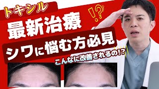 【シワ改善】最新治療のトキシルスレッドを分かりやすく紹介！【女優注射の成分】