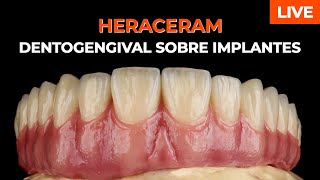 DENTOGENGIVAL SOBRE IMPLANTES - METALO-CERÂMICAS - HERACERAM