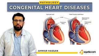 Congenital Heart Diseases | Introduction and Classification | Pathology Lectures | V-Learning™