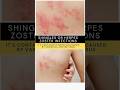 Shingles or Herpes Zoster infections #shorts #shingles #herpesvirus #healthtips