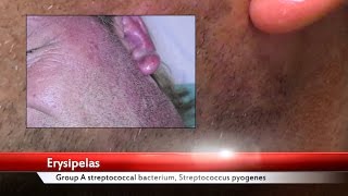 Erysipelas Facial Infection