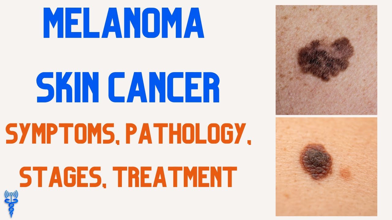 MELANOMA SKIN CANCER Symptoms, Risk Factors, Stages, Treatment - YouTube