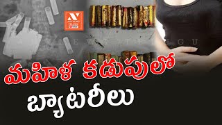 మహిళ కడుపులో 55 బ్యాటరీలు | Batteries In Woman Stomach | Ireland | AnyNews