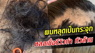 ผมหลุดเป็นกระจุก 'หัวล้าน' เพราะหลงเชื่อรีวิว แฉเจอแบบนี้อีกเพียบ!  : Khaosod - ข่าวสด