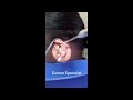 Removing Massive Earwax From Woman's Ear