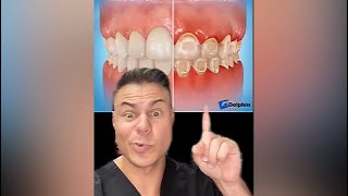 Braces Life Hack! How To Not Get White Spots With Braces!
