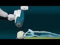 cyberknife s7 treating intracranial targets with precise radiation