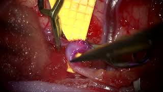 STA MCA bypass for left ICA occlusion