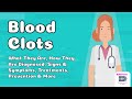 Blood Clots - What They Are, How They Are Diagnosed, Signs & Symptoms, Treatments, Prevention & More