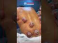 Low Back Cupping Therapy | Sports Performance Physical Therapy