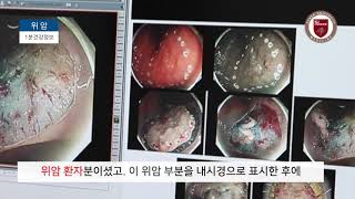 [건강정보] 내시경위암수술이 급격히 증가하고 있다고 하는데 어떤 수술방법인가요? -고려대학교안암병원 소화기센터