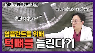 턱뼈를 늘려서 임플란트를 한다?! 난이도 높은 임플란트 케이스에 대해 알려드립니다!