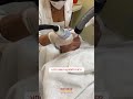 Lavieen para melasma