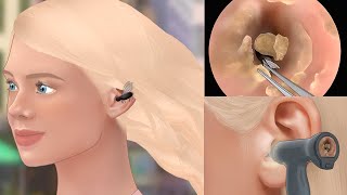Satisfying! Bug removal & ear cleaning animation | tingle sound