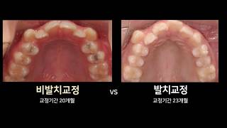 👍비발치교정 vs 👍발치교정 , 덧니 교정 전후 비교영상, Extraction Vs Non Extration Case Before \u0026 After