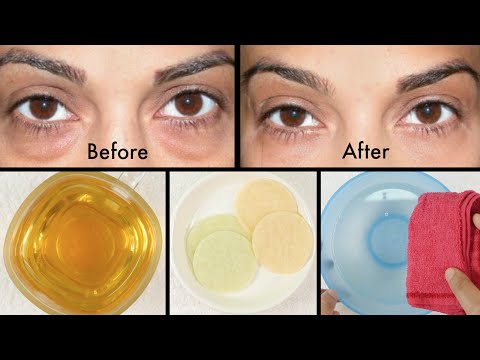 How to Get Rid of Puffy Eyes, Swollen Eyelids & Dark Circles How to Get Rid of Puffy Eyes, Swollen Eyelids & Dark Circles