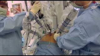 Robotic Prostate Surgery - St. David's North Austin Medical Center
