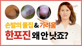 손발 물집, 피부 가려움, 갈라짐, 손톱 변화까지? 한포진 재발 이유 \u0026 관리법