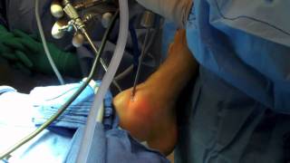 Ankle Arthroscopy